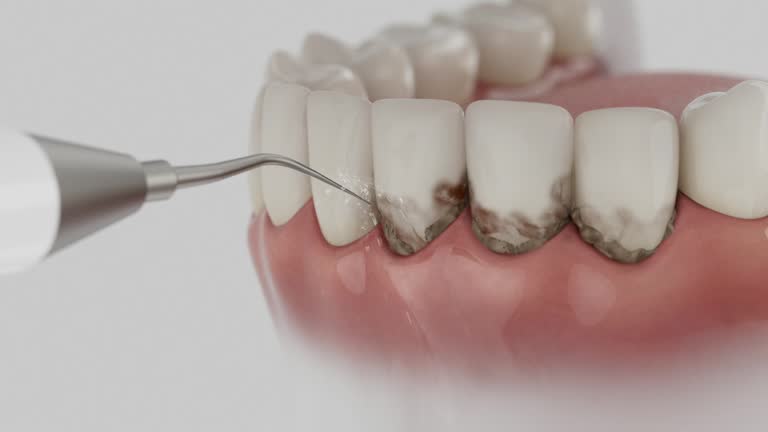 Trusted Wisdom Tooth Removal service in Mediapolis, IA - Dentist Open Now